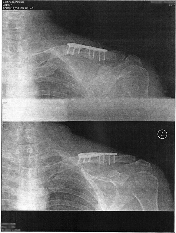 collarbonefixsm.jpg